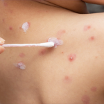 Obat Cacar Air Tradisional Paling Ampuh